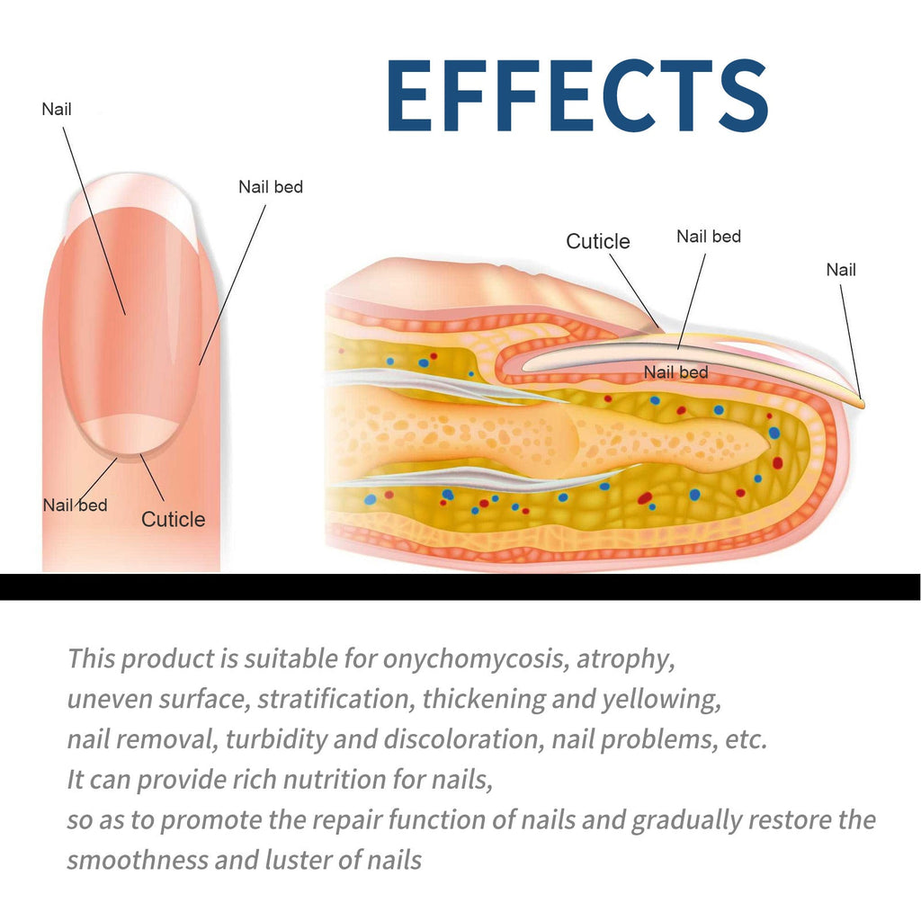 FungalCure™ - Renewal Fungal Nail Patches