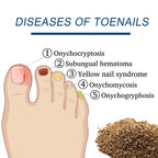 FungalCure™ - Renewal Fungal Nail Patches